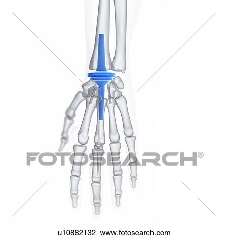 Illustration of a wrist replacement. View Large Photo Image Stock Image - Illustration of a wrist replacement.. Fotosearch