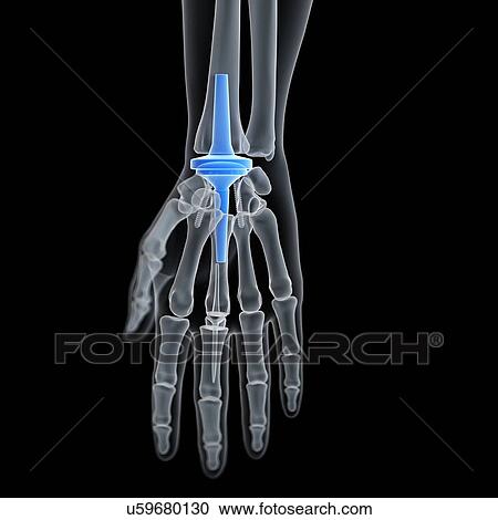 Stock Image - Illustration of a wrist replacement.. Fotosearch