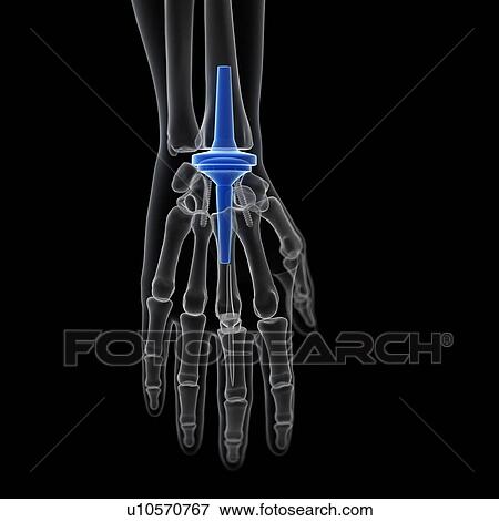 Stock Photo - Illustration of a wrist replacement.. Fotosearch