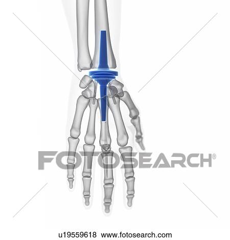 Stock Photo - Illustration of a wrist replacement.. Fotosearch