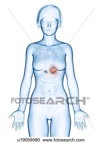 Stock Image - Illustration of adrenal gland cancer.. Fotosearch
