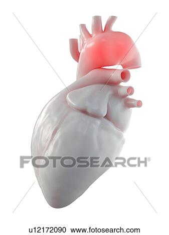 Illustration of an aortic aneurysm. View Large Photo Image Stock Image - Illustration of an aortic aneurysm.. Fotosearch