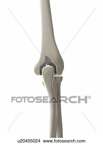 Picture - Illustration of an elbow implant.. Fotosearch