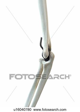 Illustration of an elbow implant. View Large Photo Image Stock Image - Illustration of an elbow implant.. Fotosearch