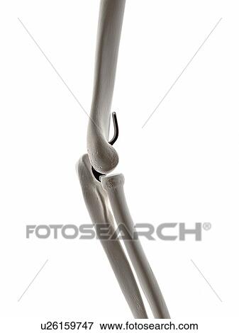 Illustration of an elbow implant. View Large Photo Image Stock Photo - Illustration of an elbow implant.. Fotosearch