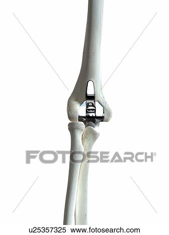 Illustration of an elbow implant. View Large Photo Image Stock Photography - Illustration of an elbow implant.. Fotosearch