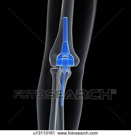 Illustration of an elbow replacement. View Large Photo Image Stock Image - Illustration of an elbow replacement.. Fotosearch