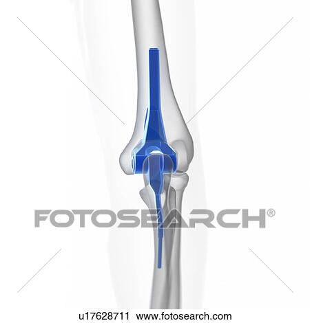 Illustration of an elbow replacement. View Large Photo Image Stock Image - Illustration of an elbow replacement.. Fotosearch