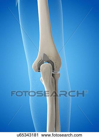 Stock Image - Illustration of an elbow replacement.. Fotosearch