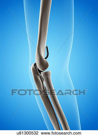 Illustration of an elbow replacement. View Large Photo Image Stock Image - Illustration of an elbow replacement.. Fotosearch