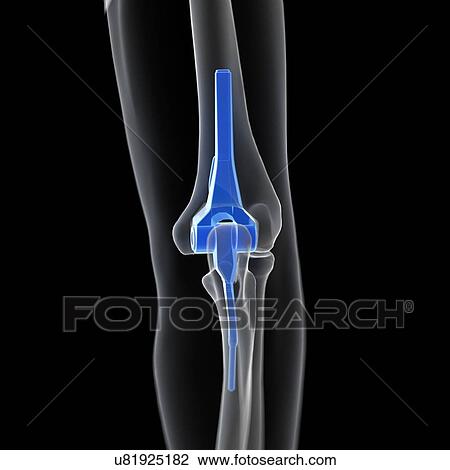 Illustration of an elbow replacement. View Large Photo Image Stock Image - Illustration of an elbow replacement.. Fotosearch