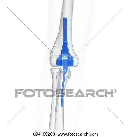 Stock Photo - Illustration of an elbow replacement.. Fotosearch