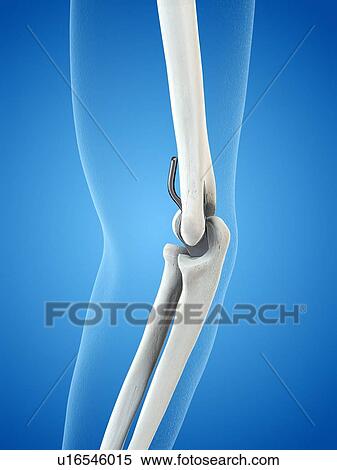 Stock Photography - Illustration of an elbow replacement.. Fotosearch