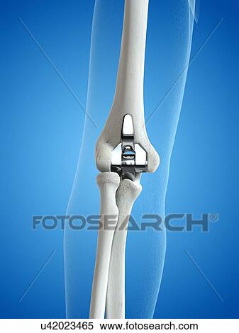 Illustration of an elbow replacement. View Large Photo Image Stock Photography - Illustration of an elbow replacement.. Fotosearch