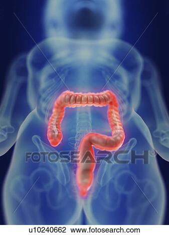 Illustration of an inflamed colon. View Large Photo Image Stock Image - Illustration of an inflamed colon.. Fotosearch