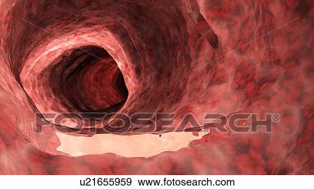 Stock Photo - Illustration of an inflamed colon.. Fotosearch