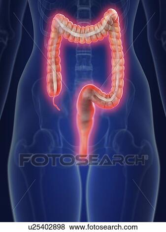 Illustration of an inflamed colon. View Large Photo Image Stock Photo - Illustration of an inflamed colon.. Fotosearch