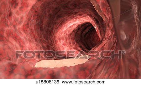 Stock Photography - Illustration of an inflamed colon.. Fotosearch