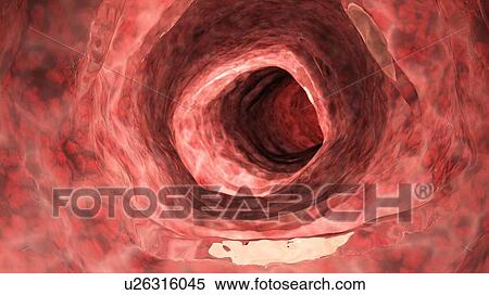 Illustration of an inflamed colon. View Large Photo Image Stock Photography - Illustration of an inflamed colon.. Fotosearch