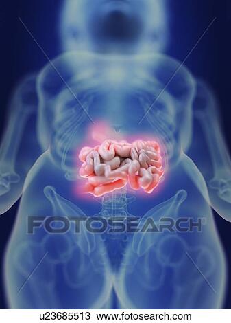 Stock Image - Illustration of an inflamed intestine.. Fotosearch
