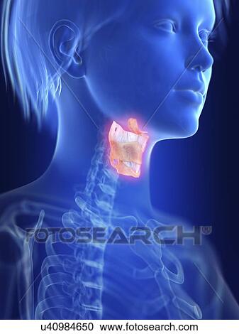 Stock Image - Illustration of an inflamed larynx.. Fotosearch