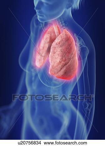Picture - Illustration of an inflamed lung.. Fotosearch