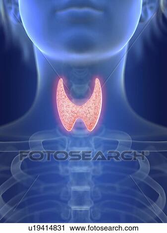 Stock Image - Illustration of an inflamed thyroid gland.. Fotosearch
