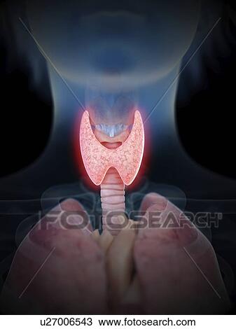 Stock Image - Illustration of an inflamed thyroid gland.. Fotosearch