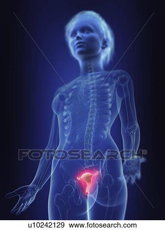 Stock Photo - Illustration of an inflamed uterus.. Fotosearch