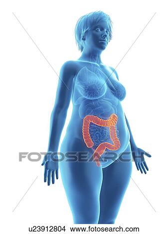 Picture - Illustration of an obese woman's colon.. Fotosearch