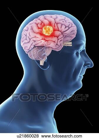 Stock Photo - Illustration of an old man's brain cancer.. Fotosearch