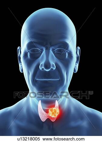 Illustration of an old man's thyroid gland cancer. View Large Photo Image Stock Photography - Illustration of an old man's thyroid gland cancer.. Fotosearch