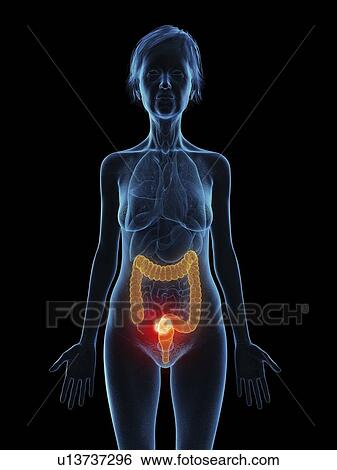 Illustration of an old woman's colon tumour. View Large Photo Image Stock Photograph - Illustration of an old woman's colon tumour.. Fotosearch