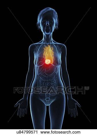 Stock Image - Illustration of an old woman's heart tumour.. Fotosearch