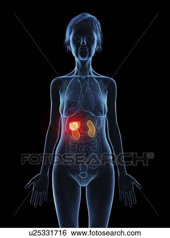 Stock Photograph - Illustration of an old woman's kidneys tumour.. Fotosearch