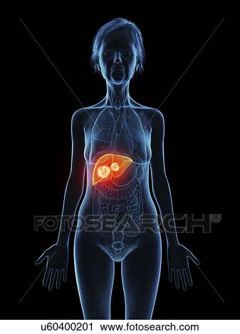 Illustration of an old woman's liver tumour. View Large Photo Image Stock Image - Illustration of an old woman's liver tumour.. Fotosearch