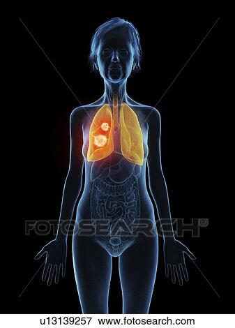 Stock Photo - Illustration of an old woman's lung tumour.. Fotosearch