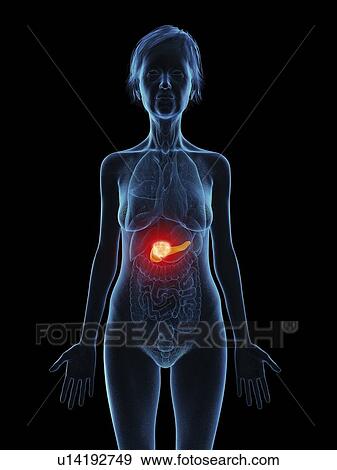 Stock Photo - Illustration of an old woman's pancreas tumour.. Fotosearch
