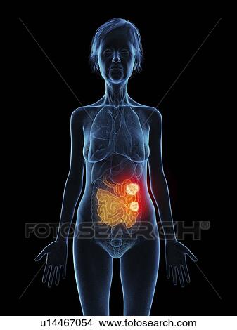 Picture - Illustration of an old woman's small intestine tumour.. Fotosearch