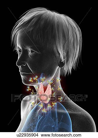 Picture - Illustration of an old woman's thyroid being attacked by antibodies.. Fotosearch