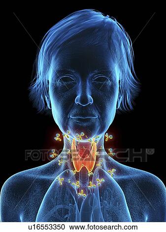 Stock Image - Illustration of an old woman's thyroid gland being attacked by antibodies.. Fotosearch