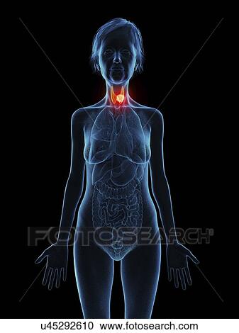Stock Image - Illustration of an old woman's thyroid gland tumour.. Fotosearch