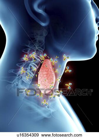 Illustration of autoimmune thyroid disease. View Large Photo Image Stock Photo - Illustration of autoimmune thyroid disease.. Fotosearch