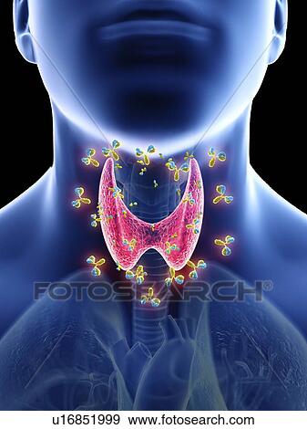 Stock Photo - Illustration of autoimmune thyroid disease.. Fotosearch