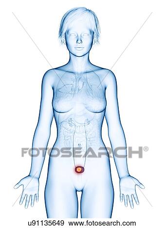 Stock Photo - Illustration of bladder cancer.. Fotosearch