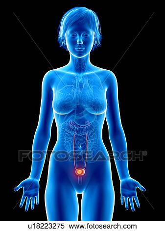 Stock Photography - Illustration of bladder cancer.. Fotosearch