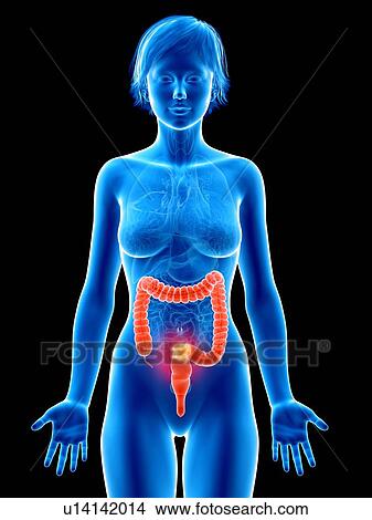 Illustration of colon cancer. View Large Photo Image Picture - Illustration of colon cancer.. Fotosearch