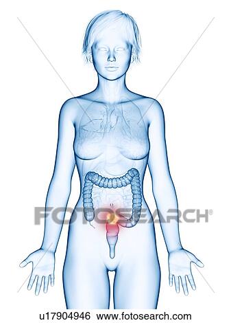 Stock Photograph - Illustration of colon cancer.. Fotosearch