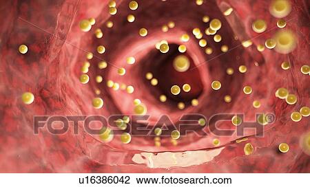 Stock Image - Illustration of colon inflammation caused by gluten.. Fotosearch