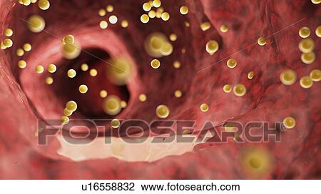 Stock Image - Illustration of colon inflammation caused by gluten.. Fotosearch